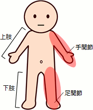 高度障害状態（1上肢または1下肢）